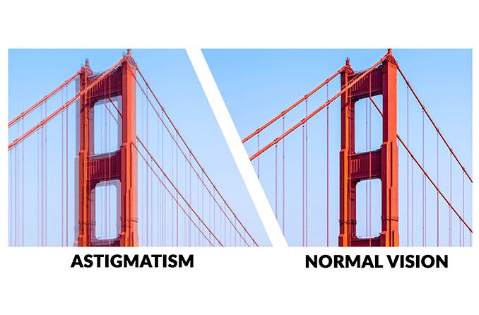Astigmatism Astigmatism