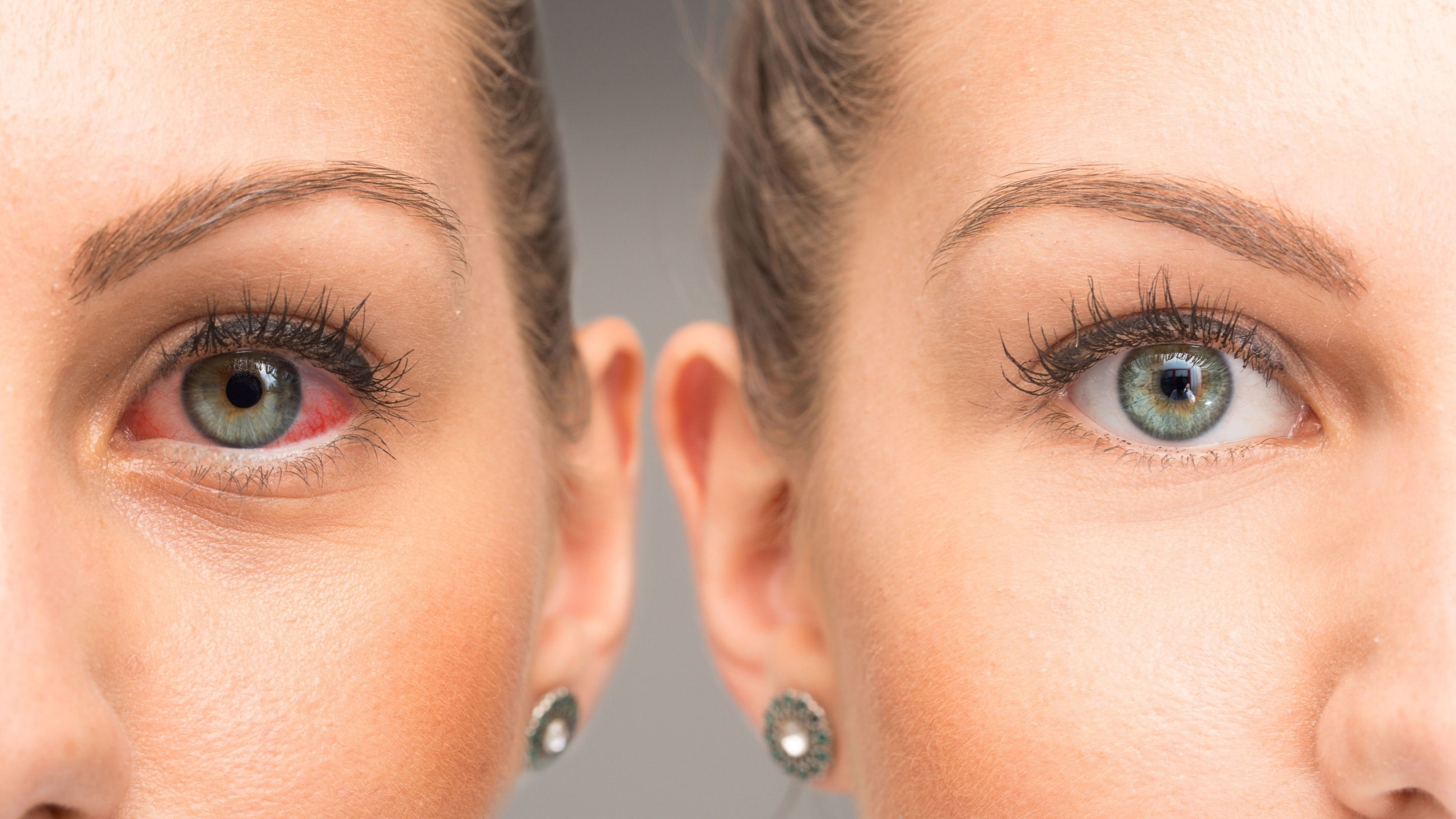 Dry eyes: Symptoms and causes Dry eyes: Symptoms and causes