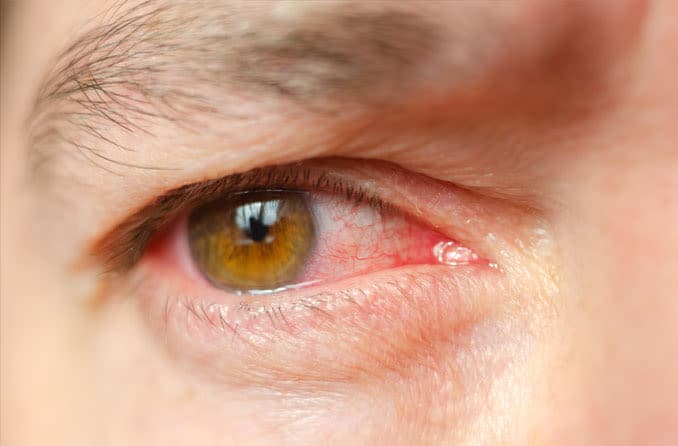 Eye infections: Causes, symptoms and treatment Eye infections: Causes, symptoms and treatment