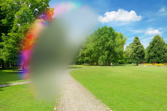 Ocular migraine(s) Ocular migraine(s)