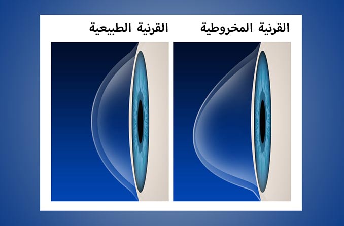 القرنية الطبيعية مقابل القرنية المخروطية القرنية الطبيعية مقابل القرنية المخروطية