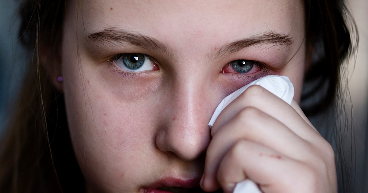 Mädchen mit Bindehautentzündung (Konjunktivitis)

