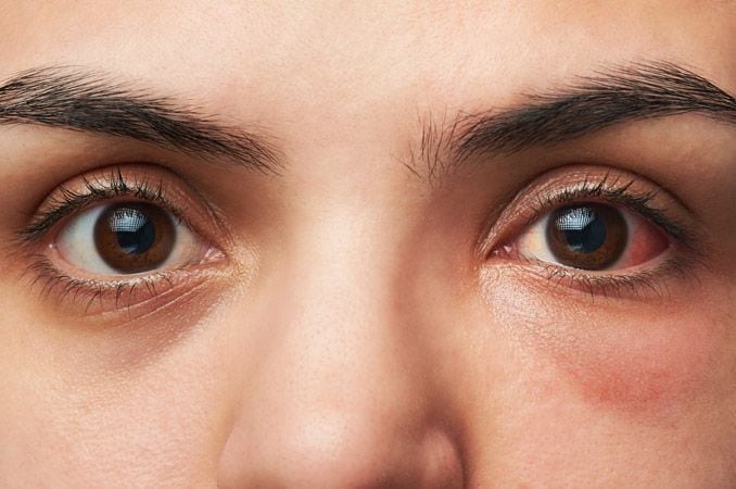 Tampilan jarak dekat dari orang dengan konjungtivitis (mata merah muda).