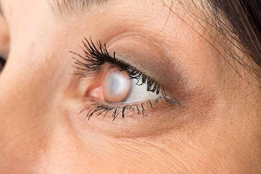 Primo piano di una giovane donna con cataratta all'occhio.