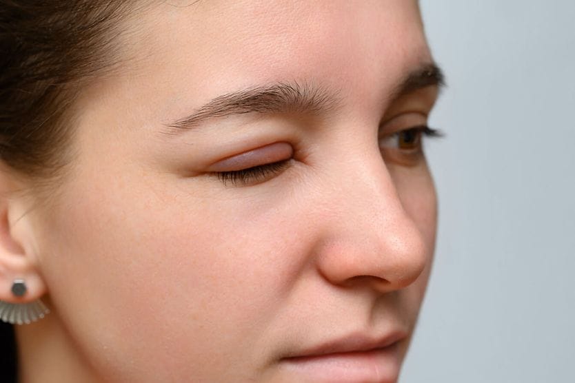 Swollen eyelid